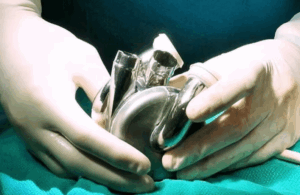 coracao-titanio-implantado-primeiro-paciente-reproducao-bivacor-galileu
