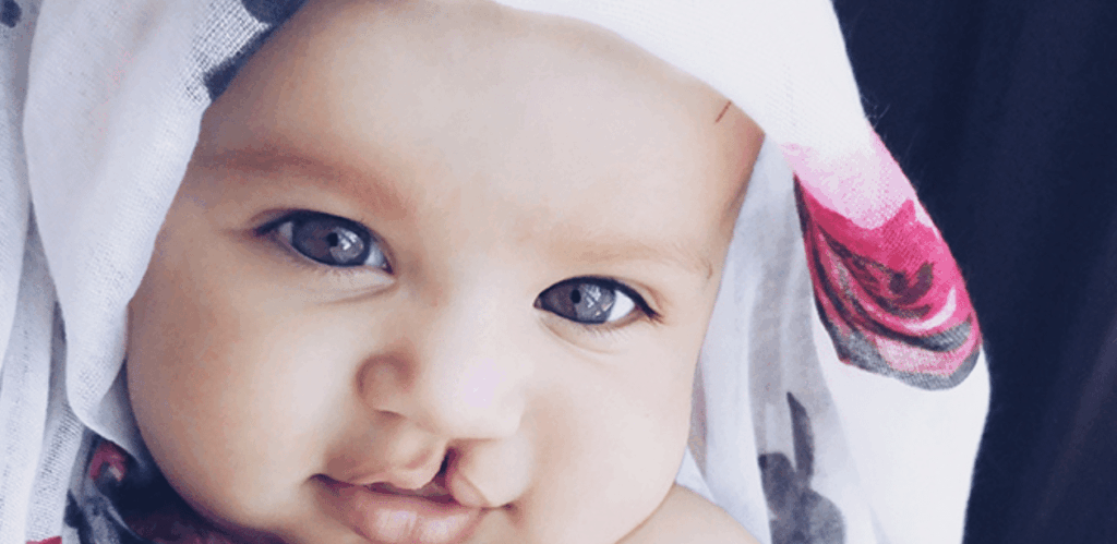 Bebê com lábio leporino usando lenço floral, representando crianças que serão beneficiadas com cirurgia de lábio leporino pelo SUS