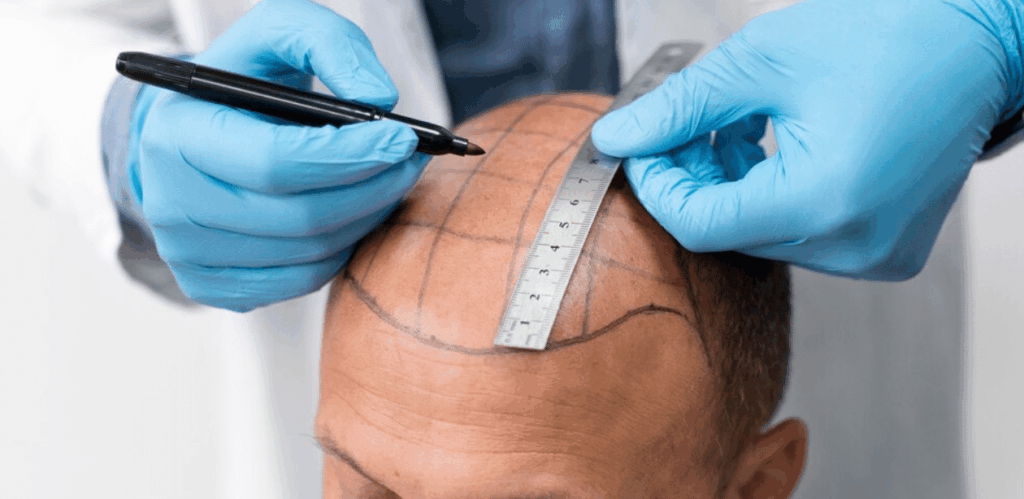 Homem passando por avaliação capilar para tratamento de queda de cabelo, possível aplicação da proteína MCL-1