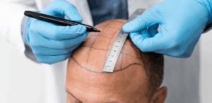 Homem passando por avaliação capilar para tratamento de queda de cabelo, possível aplicação da proteína MCL-1